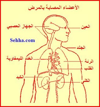 الأمراض المناعية الذاتية Autoimmune Diseases Sarcoidosis