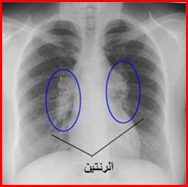 الأمراض المناعية الذاتية Autoimmune Diseases Sarcoidosis5