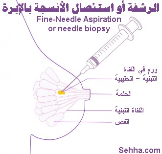 سرطان الثدي الاسباب وطرق الفحص Biopsy1