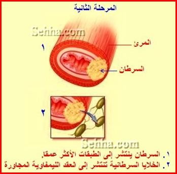 سرطان المريء Esophageal cancer Esophageal_cancer13