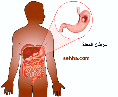 سرطان المعدة Gastric cancer Gastric-cancer01