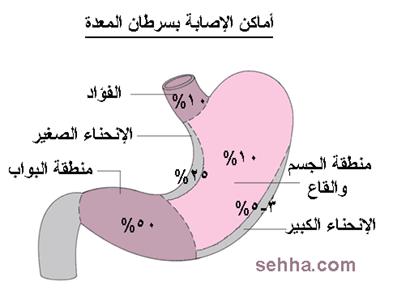 السرطان بانواعه cancer Gastric-cancer05