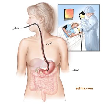 سرطان المعدة Gastric-cancer09