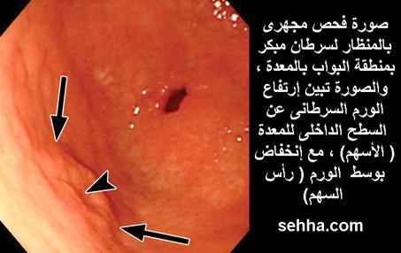 السرطان بانواعه cancer Gastric-cancer10