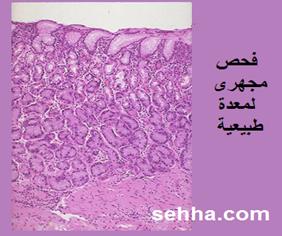 السرطان بانواعه cancer Gastric-cancer13