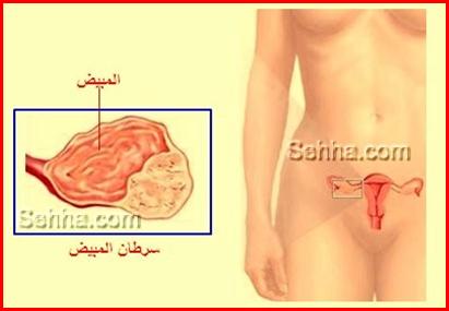 كل ما تريد معرفته عن السرطان Ovarian-Cancer02