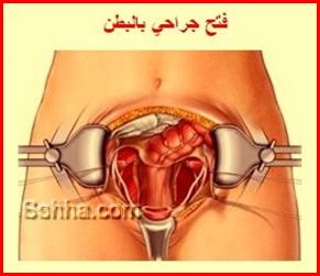 كل ما تريد معرفته عن السرطان Ovarian-Cancer06