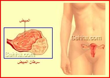 كل ما تريد معرفته عن السرطان Ovarian-Cancer11