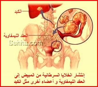 كل ما تريد معرفته عن السرطان Ovarian-Cancer14