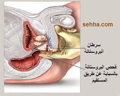 كل ما تريد معرفته عن السرطان Prostate_cancer04