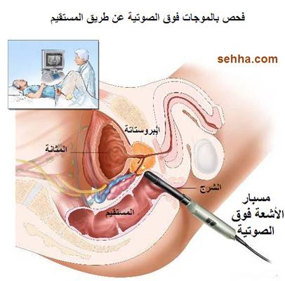 كل ما تريد معرفته عن السرطان Prostate_cancer05