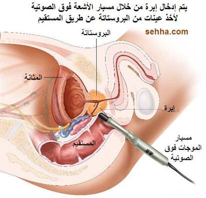 كل ما تريد معرفته عن السرطان Prostate_cancer06