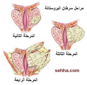 كل ما تريد معرفته عن السرطان Prostate_cancer08