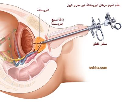 كل ما تريد معرفته عن السرطان Prostate_cancer14