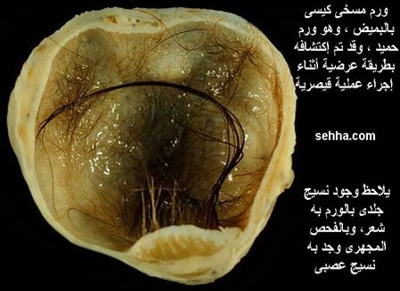 كل ما تريد معرفته عن السرطان Teratoma3