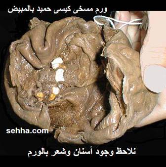 الورم المسخي Teratoma Teratoma4