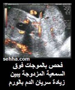 كل ما تريد معرفته عن السرطان Teratoma6