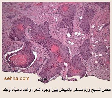 كل ما تريد معرفته عن السرطان Teratoma8