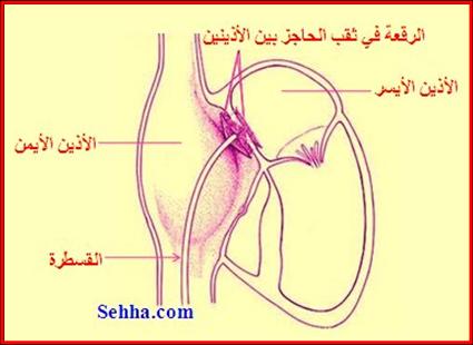 أمراض القلب و الجهاز الدوري Cardiovascular diseases ASD11