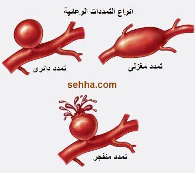 أمراض القلب و الجهاز الدوري Cardiovascular diseases Aneurysm02