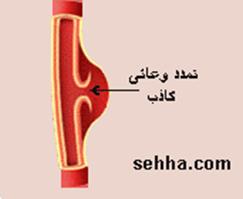 أمراض القلب و الجهاز الدوري Cardiovascular diseases Aneurysm05