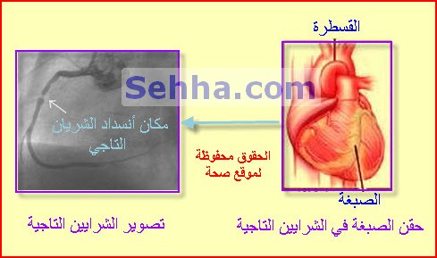 القسطرة القلبية CC05