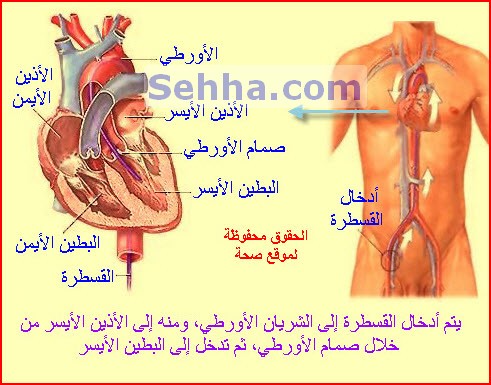 القسطرة القلبية CC06