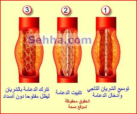 القسطرة القلبية CC09