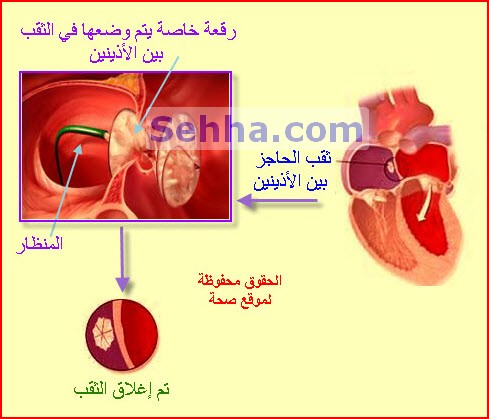 القسطرة القلبية CC11