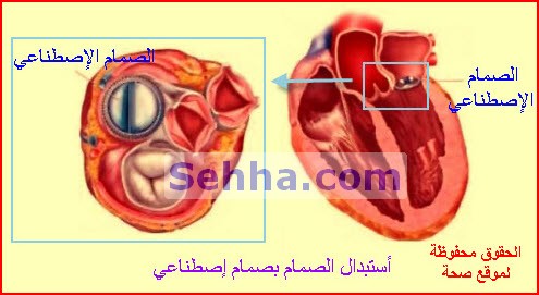 القسطرة القلبية CC12