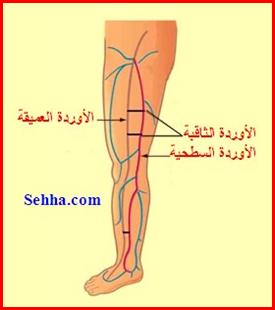 تجلط الأوردة العميقة - جلطة الساق Deep Vein Thrombosis - DVT DVT03