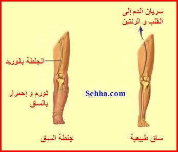 أمراض القلب و الجهاز الدوري Cardiovascular diseases DVT11