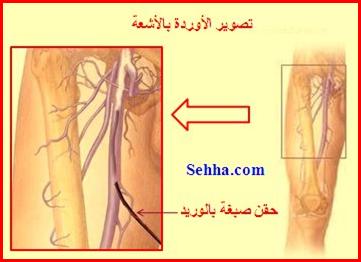 أمراض القلب و الجهاز الدوري Cardiovascular diseases DVT13