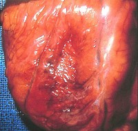 موت عضلة القلب (احتشاء عضلة القلب) Myocardial infarction MI01