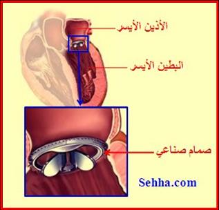 ارتخاء الصمام الميترالي Mitral Valve Prolapse MVP10