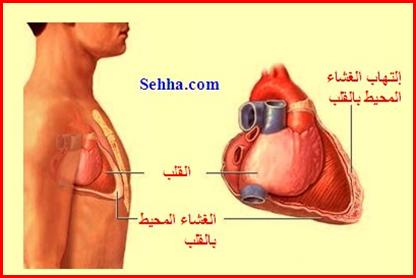 القلب The heart Myocarditis04