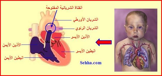 أمراض القلب و الجهاز الدوري Cardiovascular diseases PDA