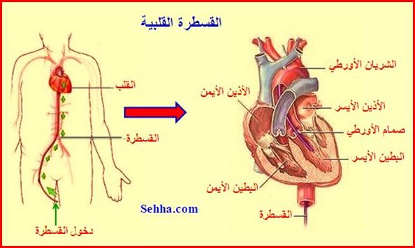 القناة الشريانية المفتوحة Patent Ductus Arteriosus - PDA PDA8