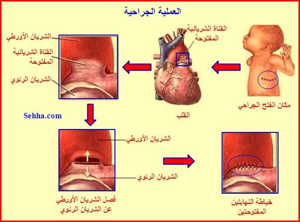 أمراض القلب و الجهاز الدوري Cardiovascular diseases PDA9