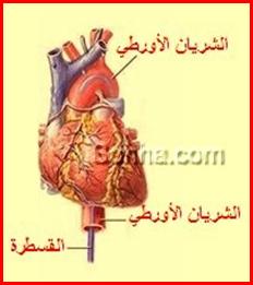 رباعية فالوت Tetralogy of Fallot Tetralogy-of-Fallot9