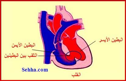 ثقب الحاجز بين البطينين Ventricular Septal Defect - VSD VSD