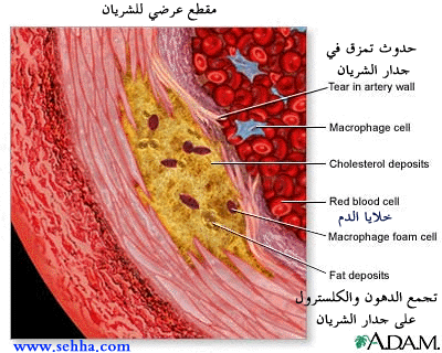 تصلب الشرايين و الوقاية منه Arterioscl2