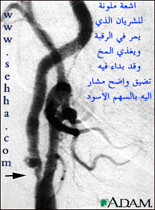 تصلب الشرايين Arteriosclerosis   (د. جمال عبدالله باصهي ) Arterioscl5