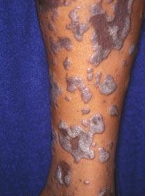 الحزاز المسطح - مقدمة Lichen planus Lichen-Planus17