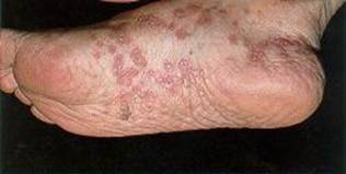 الحزاز المسطح Lichen planus Lichen-Planus3