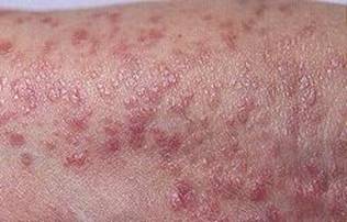 الحزاز المسطح - مقدمة Lichen planus Lichen-Planus4