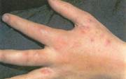 فرط التعرق Hyperhidrosis Scabies3