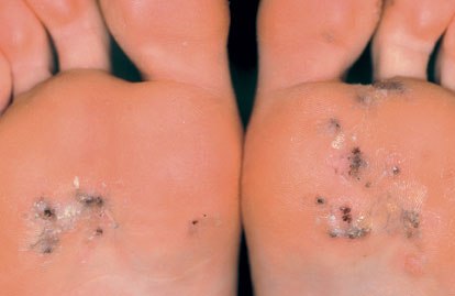 الثآليل الجلدية الفيروسية - السنط Viral warts of skin ViralWarts09