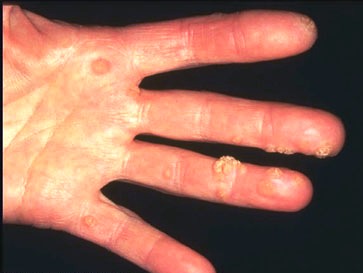 الثآليل الجلدية الفيروسية - السنط Viral warts of skin ViralWarts11