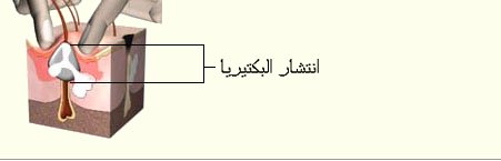 الأمراض الجلدية تابع شرح كامل ومفصل لمكونات وامراض كل عضو من اعضاء جسم الانسان ..التمدد الوعائي Aneurysm Acne5